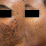 Hyperpigmentation / Dark spot Kit